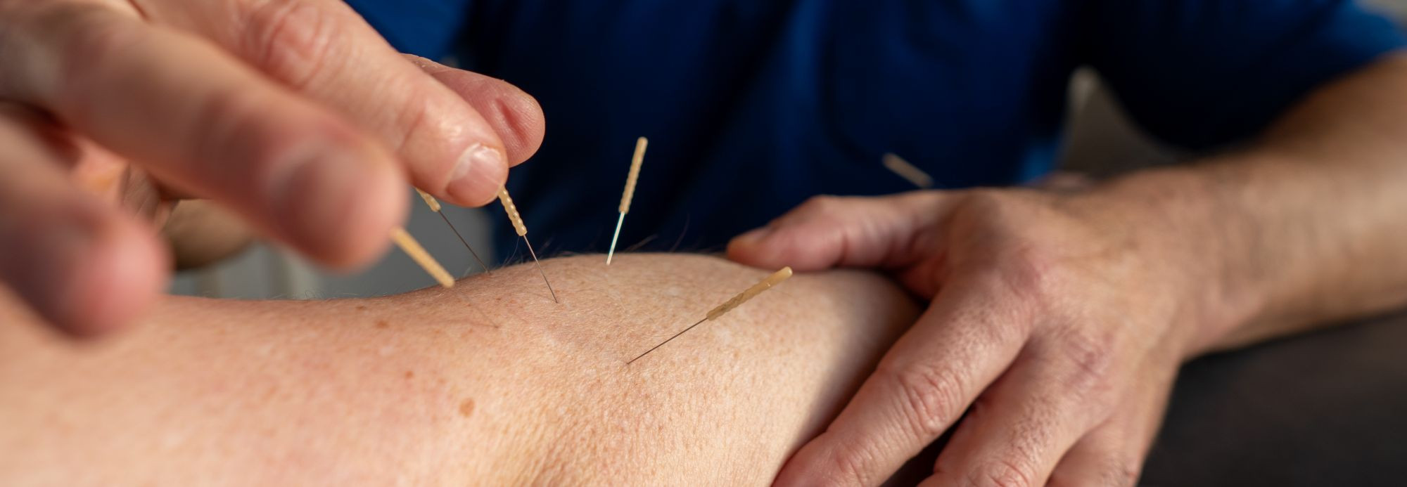 Akupunktur
